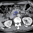 2022 09 07 17 21 8488 2022 09 08 Ai Ct Pancreatic Figure3 20220907170529