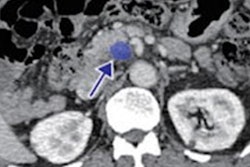 2022 09 07 17 21 8488 2022 09 08 Ai Ct Pancreatic Figure3 20220907170529