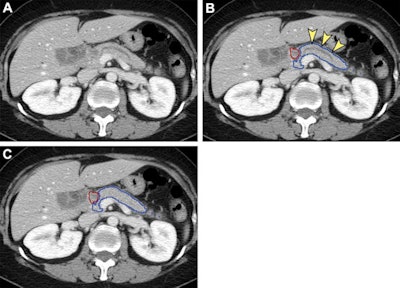 Analysis of nontumorous portion of pancreas with or without secondary signs of pancreatic cancer by classification models. Blue outline represents the portion of the pancreas analyzed with classification models. The tumor (red outline) was not identified by the segmentation model; thus, it was not analyzed by classification models. (A) Unannotated CT image in a patient with pancreatic head cancer. (B) Nontumorous portion of the pancreas shows secondary signs of pancreatic cancer (dilation of pancreatic duct with abrupt cutoff shown by arrowheads) and was classified as cancerous by the classification models. (C) Nontumorous portion of the pancreas appeared normal and was classified as noncancerous after the dilated duct was replaced and imputed with surrounding normal-appearing pancreas parenchyma. Images and caption courtesy of the RSNA.