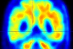 2022 09 13 17 40 2157 2022 09 13 Pet Donanemab 400