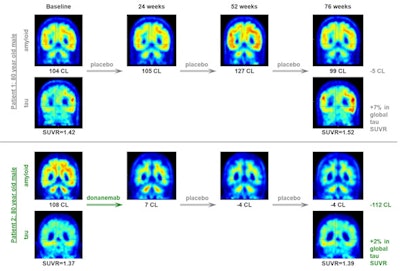 Representative amyloid and tau PET scans showing changes after placebo and donanemab treatment over the course of 76 weeks. Tau level is measured using an Alzheimer's disease-signature weighted neocortical SUVR (standardized uptake value ratio) with respect to cerebellum gray as a reference. Image courtesy of JAMA Neurology.