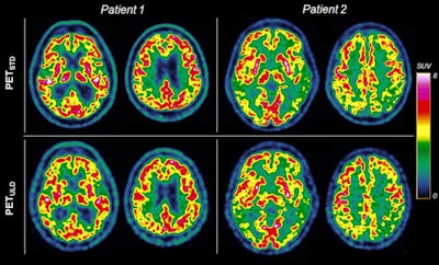 Transverse slices of two patients suspected of Alzheimer's disease with mild hypometabolism (patient 1) and severe hypometabolism (patient 2) with standard-dose (PET/STD, 2 MBq/kg) and ultralow-dose (PET/ULD, 0.2 MBq/kg) protocol. The transverse slices are extracted from the Advantage Workstation (AW server 3.2, GE Healthcare) used to carry out the interpretation. Image courtesy of Scientific Reports.