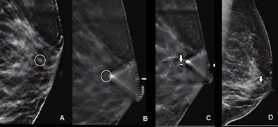 Images of a 55-year-old woman show suspicious calcifications that were recommended for biopsy. Calcifications spanned 0.6 cm in the retroareolar left breast. On the day of the procedure, the radiologist performed a DBT-guided biopsy. (A) Scout image obtained for targeting purposes demonstrates grouped amorphous calcifications (circle). (B) Prefire image obtained to confirm needle position shows tip of biopsy device adjacent to targeted calcifications (circle). (C) Postsampling image documents biopsy clip deployment (arrow). D. Postprocedure synthetic 2D diagnostic mammogram mediolateral view shows biopsy clip in appropriate position (arrow). Biopsy result was invasive ductal carcinoma. Images courtesy of ARRS.