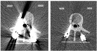 Improved visualization of arteries of the hand up to digital branches due to higher spatial resolution of photon-counting CT. Image courtesy of Cynthia McCollough, PhD.