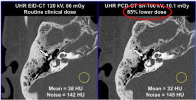 Bony trabecula and scaphoid fracture line are better seen with photon-counting CT with an approximately 50% dose savings. Increased sharpness is due to the spatial resolution and sharper reconstruction kernel permissible with photon-counting CT. UHR = ultrahigh resolution. EID = energy-integrating detector. PCD = photon-counting detector. Image courtesy of Cynthia McCollough, PhD.