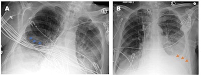 Two portable chest x-rays from a patient acquired at different times of the same day. The rotated and mispositioned film (A) cuts off the left cardiophrenic angle, which ended up concealing a large left-sided pleural effusion (orange arrows). The cardiac silhouette appears exaggerated and the EKG wires (blue arrows) severely obscure evaluation of the right lower chest and the right lower lobe airspace opacities. Image courtesy of Cureus.