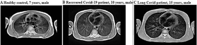 Images acquired in a healthy control (male, 7 years), participant recovered from COVID-19 (male, 10 years) and a participant with long COVID (male, 15 years). Unenhanced axial turbo spin-echo (TSE) sequence with BLADE (periodically rotated overlapping parallel lines with enhanced reconstruction) readout and respiration-gating. Images and caption courtesy of the RSNA.