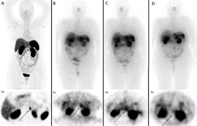 A 56-year-old woman with raised calcitonin levels following thyroidectomy, and therefore suspected of recurrent MTC, underwent Ga-68 DOTATATE PET/CT. Results show radiotracer uptake in the pancreatic tail (maximum standardized uptake value [SUVmax], 10.5) and left kidney (SUVmax, 11.8) (A). The patient underwent three cycles of peptide receptor radionuclide therapy with Lu-177 DOTATATE (10.5 GBq). Post-treatment scintigraphy after the first (B) and second (C) cycles showed an accumulation of radiotracer in the lesions, which was significantly reduced in the third cycle (D), revealing partial response. Image courtesy of Annals of Endocrinology.