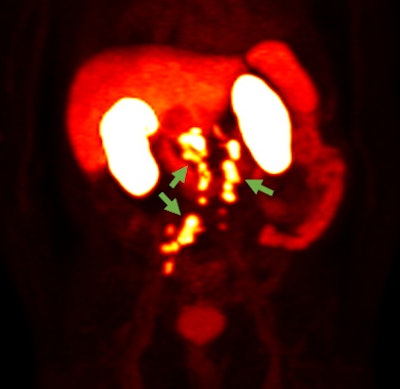 F-18 rhPSMA-7.3 PET image showing prostate cancer spread beyond the prostate region. Photo courtesy of Blue Earth Diagnostics.