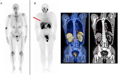 A 66-year-old patient with biochemical recurrence of prostate cancer. The patient's Gleason score was 7, and the PSA level was 3.14 ng/mL. (A) Whole-body planar Tc-99m MDP. (B) Whole-body planar Tc-99m PSMA and coronal SPECT/CT. Tc-99m PSMA-SPECT/CT helped identify lung metastasis (B, red arrow and cross). Image courtesy of Scientific Reports.