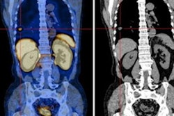 2022 09 27 23 26 3169 2022 09 28 Spect Prostate Cancer 20220927235956