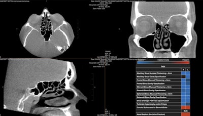 InformAI’s lead product – SinusAI – is an AI algorithm that detects and distinguishes several conditions and features prevalent in the paranasal sinuses. Image courtesy of InformAI.