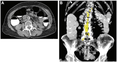 Abdominal aortic calcium in a 74-year-old woman who underwent CT colonography for colon cancer screening in 2008 and suffered a subsequent acute myocardial infarction one year later. (A) Axial noncontrast CT image at the L3 level. (B) Coronal maximum intensity projection CT image shows quantification of aortic calcium (yellow). The patient's aortic calcium Agatston score was 4137, while the 90% specificity threshold aortic calcium Agatston score was 735. Images and caption courtesy of the RSNA.