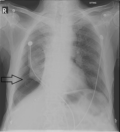 Right-sided pneumothorax (black arrow) reported by both the resident and the attending radiologist. Image courtesy of Cureus.