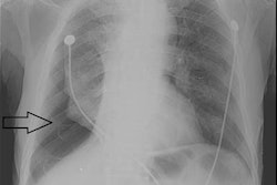 2022 09 28 23 53 7697 2022 09 29 Pneumothorax 20220928233312
