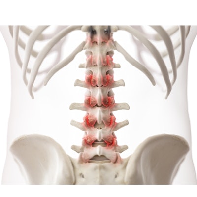 2022 02 02 23 31 1840 3d Rendered Arthritic Lumbar Spine 400