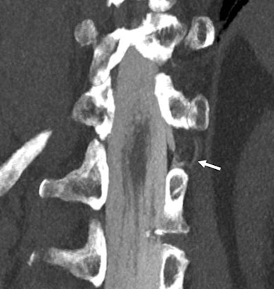 Coronal 3-mm maximum intensity projection image of a CSF-venous fistula (arrow indicates the iodinated contrast in the fistula). This was not detected on regular clinical CT with a 0.6-mm resolution but was clearly depicted on a newly U.S. Food and Drug Administration-approved photon-counting CT scanner with 0.2-mm resolution. Images and caption courtesy of Dr. Fides Schwartz.