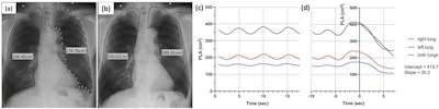 A 79-year-old male with mild COPD. Projected lung areas (PLA) of (a) tidal inspiratory phase and (b) forced inspiratory phase. Image (a) describes manually located white dots in the left lung field, which were used for automatic calculation of left PLA. Curve graphs describe the temporal change of PLA by automated tracking in (c) tidal and (d) forced respiration. Approximate straight line during forced expiration is colored purple. Image courtesy of the European Journal of Radiology.