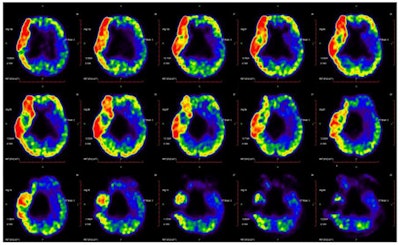 Pattern related to cerebral palsy is identified by analysis of F-18 FDG-PET scans from 31 patients. The glucose metabolism in the left cerebellum is relatively higher than in the right hemisphere. Image courtesy of Frontiers in Neurology.