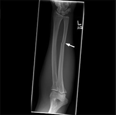 An anteroposterior radiograph of the left forearm of a patient demonstrates an acute minimally displaced fracture of the ulnar diaphysis (white arrow), compatible with a “nightstick fracture.” Image courtesy of Radiologic Clinics of North America.