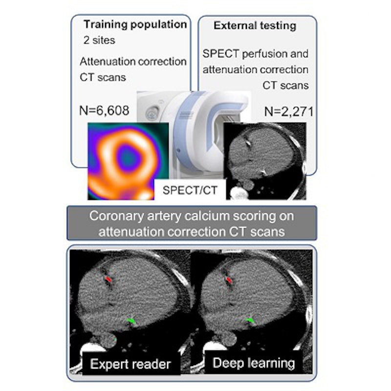 SPECT/CT AI model predicts major adverse cardiac events | AuntMinnie