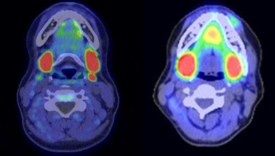 On the left, a C-11 choline PET/CT image used to identify an undescended left parathyroid gland posterior to submandibular gland; on the right, a comparative SPECT image that was unable to identify the gland. Image courtesy of Surgery.