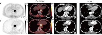 A: F-18 FAPI-04 PET/CT and CT images of a patient with locally advanced esophageal squamous cell carcinoma (LA-ESCC) with an outcome classified as partial response. B: F-18 FAPI-04 PET/CT and CT images of an LA-ESCC patient with an outcome classified as stable disease. Images courtesy of the Journal of Nuclear Medicine.