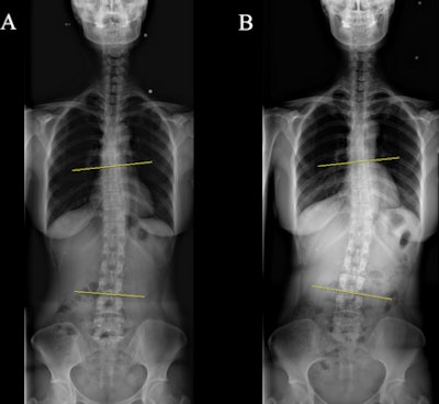 Demonstration of Cobb angle on whole-spine radiograph in one patient with a significant change in spinal curve; (A) initial radiograph, (B) follow-up radiograph. Image courtesy of PLOS One.