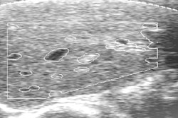 2022 10 18 20 54 8755 2022 10 18 Radiology Weijers Ultrasound Liver Staging 400