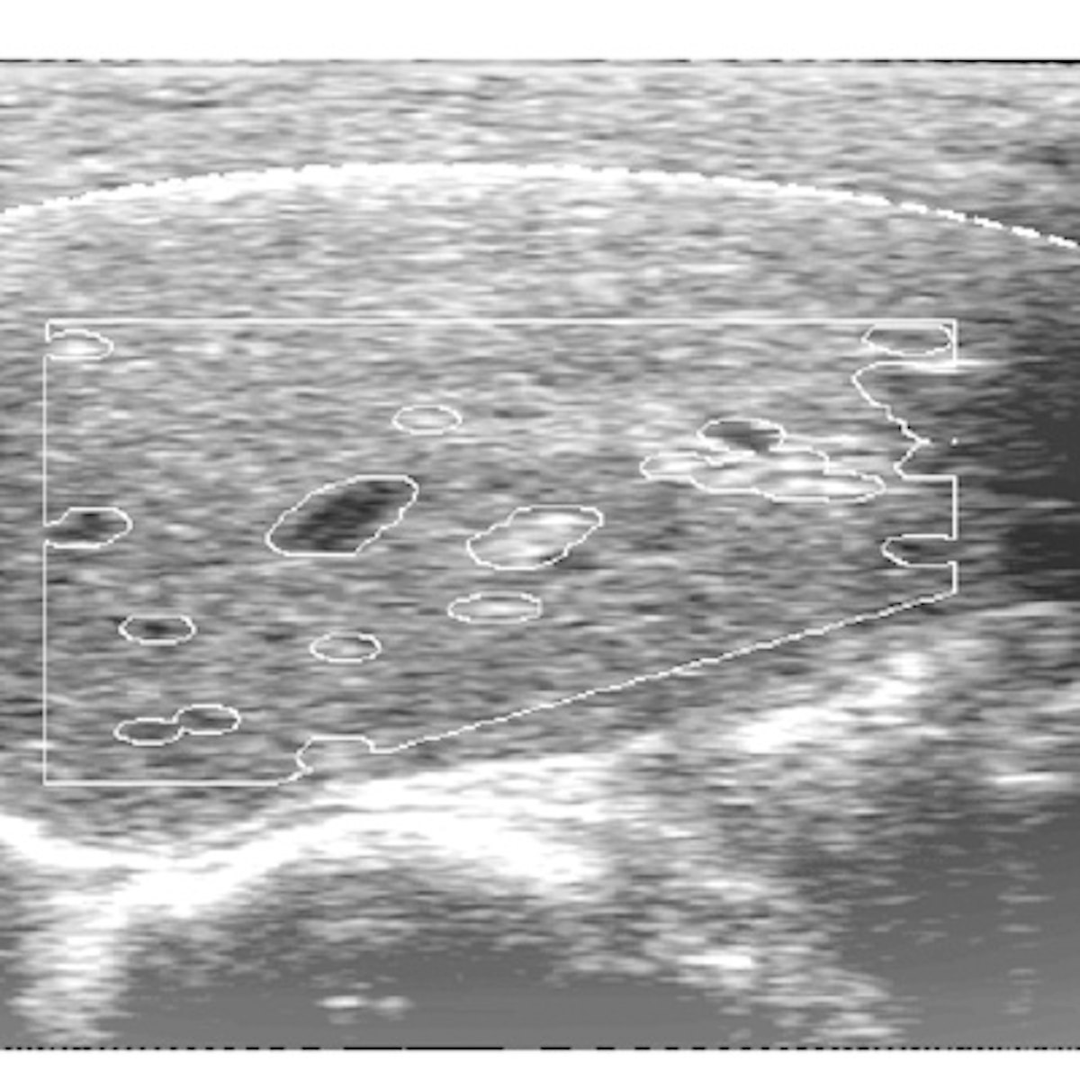 Ultrasound can be alternative for biopsy in liver disease patients