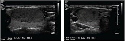 Longitudinal and transverse grayscale ultrasound images show a thyroid nodule in a 17-year-old patient with benign follicular adenoma, based on surgical excision alone. The overall impression for all three radiologists was benign (true negative). The ACR TI-RADS recommendation for all three radiologists was fine-needle aspiration (false positive). The deep-learning algorithm recommendation was also fine-needle aspiration (false positive). Images courtesy of ARRS.
