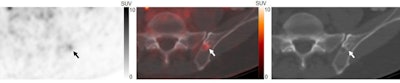 A 60-year-old patient with biochemically recurrent prostate cancer and a PSA level of 3.9 ng/mL. Axial F-18 DCFPyL PET (left), F-18 DCFPyL PET/CT (middle), and CT (right) images show a single subtle PSMA-avid uptake with SUVmax of 3.9 in the left iliac bone and mixed sclerotic/lytic CT features (arrows). This indeterminate bone lesion (IBL) was stable for four months and negative on four other staging modalities; thus, the IBL was determined to be benign. Image courtesy of the Journal of Nuclear Medicine.