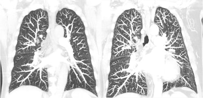 Coronal chest, with conventional CT with energy-integrating detectors (EIDs) on the left and photon-counting detector CT on the right. Courtesy of Cynthia McCollough, PhD.