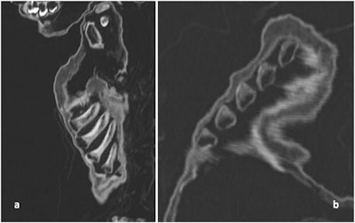 CT scan of the costochondral junction with an enlargement such as seen in 'rickety rosary' but also in 'scurvy rosary.' (a) Sagittal section; (b) oblique section.