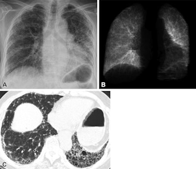 Images of a 72-year-old woman with idiopathic pulmonary fibrosis with an estimated total lung capacity of 2.96 L. (A) Posteroanterior chest radiograph; (B) the corresponding segmented lungs of the chest radiograph; and (C) unenhanced axial chest CT scan. The patient died 20.3 months after the date of the chest radiograph. Image courtesy of Radiology.