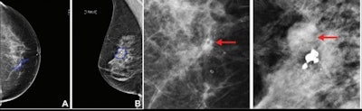 Examples of digital mammograms from the data set. The right two images correspond to an enlarged annotated region drawn by the radiologist (blue contour was removed to better see the lesions). (A) Right craniocaudal screening mammogram in a 52-year-old woman shows DCIS. Regional heterogeneous calcifications are seen in the central middle right breast (arrow, bottom image). DCIS was later confirmed at core biopsy. (B) Right mediolateral oblique image in a 70-year-old woman with heterogeneously dense breasts and obscure small masses shows invasive carcinoma. Large dystrophic calcifications in the upper outer aspect of the right breast, 10:00 region, were found to be BI-RADS 4 (arrow, far right image). The patient was diagnosed with invasive ductal carcinoma confirmed at tissue biopsy. Images courtesy of the RSNA.