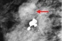 2022 10 27 22 10 4788 2022 10 25 Radiology Ai Mammo 2 Wide 20221027223200