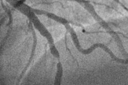 2022 10 28 23 25 6599 2022 10 31 Ctca Heart Attack Figure4 20221028235705