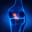 2019 08 23 21 27 6833 Knee Joint Torn Acl 400