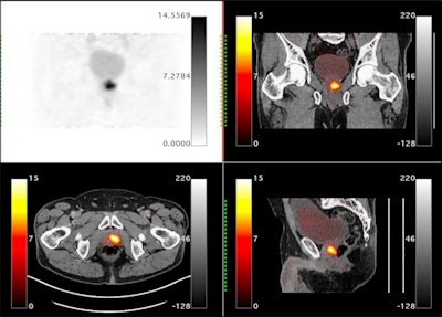 Orthogonal views are shown for a 65-year-old male with PSA = 7.3 and a biopsy showing 4+3 on the right and 4+4 on the left. The extraprostatic extension (EPE) was accurately predicted to be on the left side only by the Ga-68 P16-093-PET scan. The patient had increased preservation of the neurovascular bundle on the right side due to the PET scan. The surgical margins were negative for cancer. Image courtesy of Urologic Oncology.