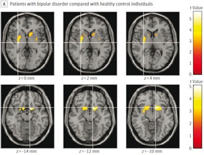 Areas in striatum where carbon-11 d-threo-methylphenidate nondisplaceable binding potential was significantly lower. Image courtesy of JAMA Psychiatry.