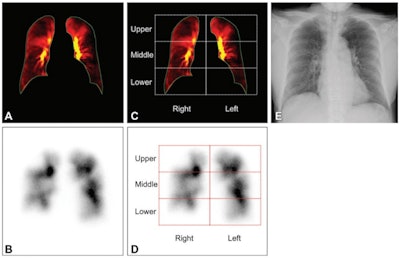 Images in a 61-year-old woman with chronic thromboembolic pulmonary hypertension. (A) Perfusion map of dynamic chest radiography and (B) anteroposterior view of planar perfusion scintigraphy, with (C, D) corresponding bilateral lung segmentations and (E) chest radiograph. Images and caption courtesy of the RSNA.