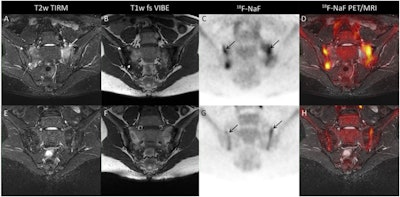 Atherosclerotic inflammation captured by F-18 FDG-PET/MRI. Image courtesy of Seminars in Nuclear Medicine.