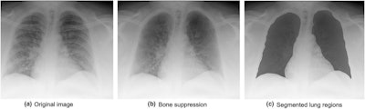 Examples of images with bone suppression and manually segmented lung regions. Courtesy of the Journal of Medical Radiation Sciences.