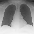 2022 11 14 18 29 0531 2022 11 14 Covid 19 X Ray 20221114183121