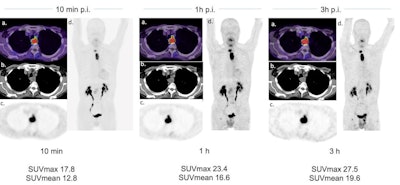 A case example of a 63-year-old patient with esophageal cancer. FAPI-46 PET/CT was performed for irradiation planning before definitive radiochemotherapy. FAPI-46 PET was performed 10 minutes, one hour, and three hours after injection. Image courtesy of the Journal of Nuclear Medicine.