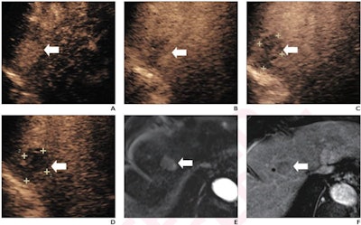 (A) Arterial-phase CEUS image shows a 25-mm segment-8 lesion with non-rim hyperenhancement (arrow). (B) CEUS image in portal-venous phase shows corresponding early washout (arrow). (C) CEUS image in late phase shows corresponding late and mild washout (arrow). (D) CEUS image in Kupffer phase shows marked Kupffer defect (arrow). The patient, a 71-year-old woman, also underwent evaluation by dynamic contrast-enhanced MRI using gadoxetate disodium. (E) Axial arterial-phase image shows 23-mm segment-8 lesion with non-rim arterial phase hyperenhancement (arrow). (F) Axial portal-venous phase image shows corresponding non-peripheral washout (arrow). This observation was classified as LR-M by modified CEUS criteria using perfluorobutane, and as LR-5 by CT/MRI LI-RADS v2018. The pathologic diagnosis based on surgical resection was intrahepatic cholangiocarcinoma. Images courtesy of ARRS.