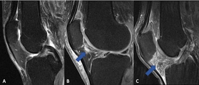 The fat pad adjacent to the kneecap (Hoffa's fat pad, infrapatellar fat pad) can change in signal on MRI when the knee is inflamed. (A) Normal knee without signs of inflammation. (B) Arrow pointing on a circumscribed area with higher signal (bright lines) in the area of the fat pad (normally dark), which is indicative of a beginning inflammatory reaction. (C) The whole fat pad has a higher signal (light grey color with white lines), which is a sign of progressive inflammation of the knee joint. Image and caption courtesy of the RSNA.