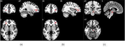 Group analysis on susceptibility-weighted imaging exhibiting higher susceptibility-weighted imaging values in the COVID group when compared to healthy controls. Three significant clusters were found primarily in the white matter regions of the prefrontal cortex and in the brainstem. The clusters (A) and (B) are observed bilaterally in the cerebral white matter near the orbitofrontal gyrus, whereas (C) lies in the midbrain region. Image and caption courtesy of the RSNA and Sapna Mishra.