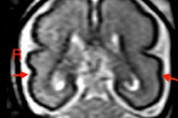 2022 11 21 19 13 5563 2022 11 22 Rsna Pr Baby 400
